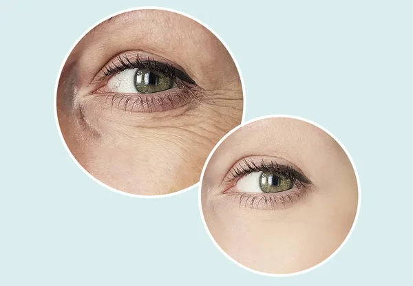 woman eye wrinkles before and after procedures retouching