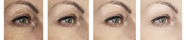 Kadın Göz Kırışıklıkları Öncesi Sonrası Yordamları Rötuş — Stok fotoğraf