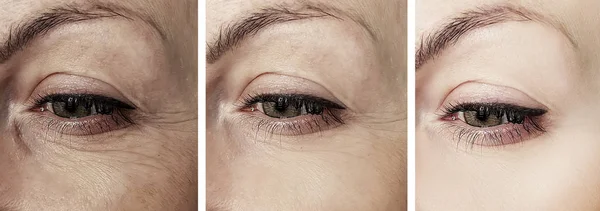 Γυναίκα Μάτια Ρυτίδες Πριν Και Μετά Από Διαδικασίες — Φωτογραφία Αρχείου