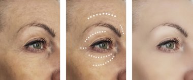 kadın kırışıklıkları öncesi ve tedavi sonrası