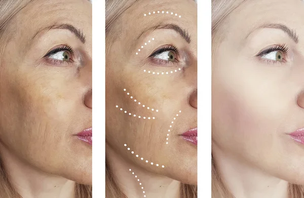 Woman Wrinkles Treatments — Stock Photo, Image