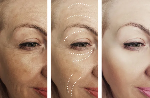 Woman Wrinkles Treatments — Stock Photo, Image