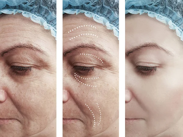 Woman Wrinkles Procedures — Stock Photo, Image