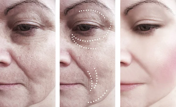 Woman Wrinkles Procedures — Stock Photo, Image