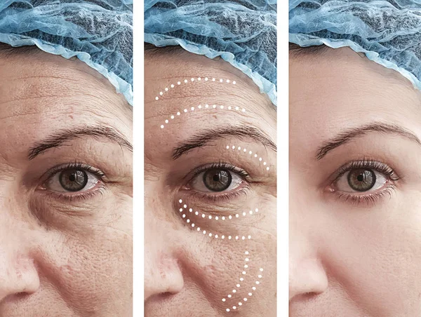 Woman Wrinkles Procedures — Stock Photo, Image
