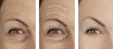 kadın kırışıklıkları öncesi ve tedavi sonrası