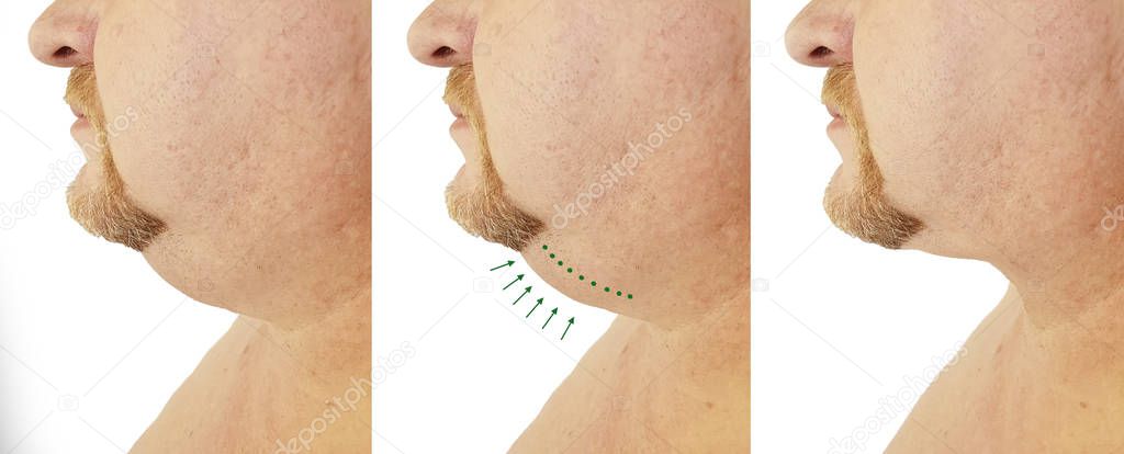 submental fat man before and after, procedures