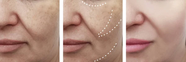 Female Facial Wrinkles Procedures — Stock Photo, Image