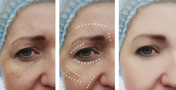 Riduri Faciale Feminine Înainte După Proceduri — Fotografie, imagine de stoc