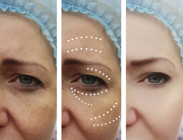 Female Facial Wrinkles Procedures — Stock Photo, Image