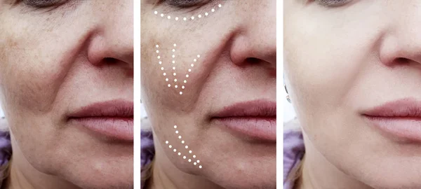 Arrugas Faciales Femeninas Antes Después Los Procedimientos — Foto de Stock