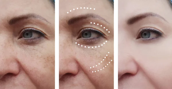Female Facial Wrinkles Procedures — Stock Photo, Image