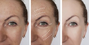 kadın kırışıklıkları öncesi ve sonrası yordamları