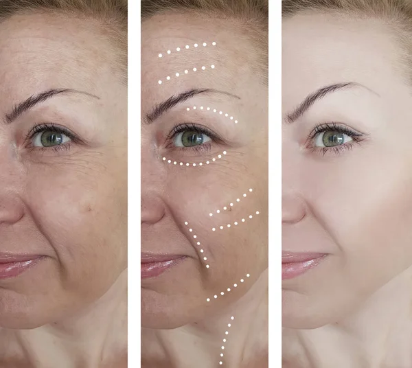 Arrugas Mujer Antes Después Procedimientos —  Fotos de Stock
