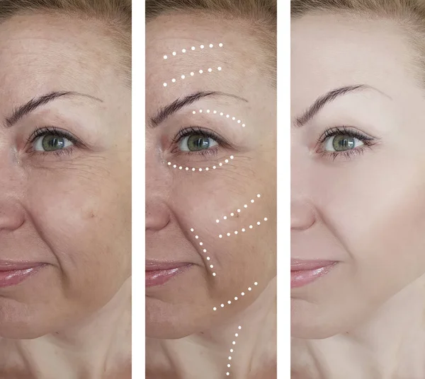 Woman Wrinkles Procedures — Stock Photo, Image