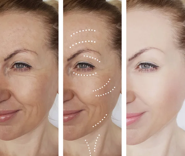 Woman Wrinkles Procedures — Stock Photo, Image