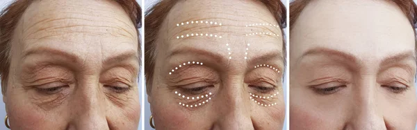 Elderly Woman Wrinkles Procedures — Stock Photo, Image