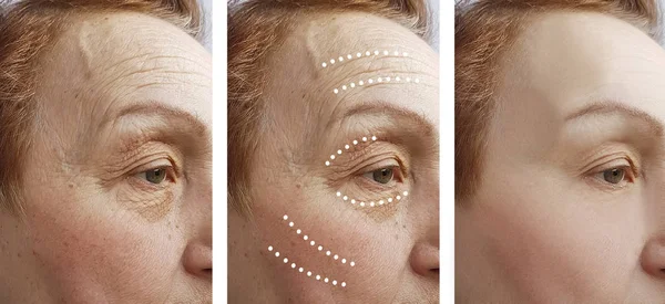 Elderly Woman Wrinkles Procedures — Stock Photo, Image