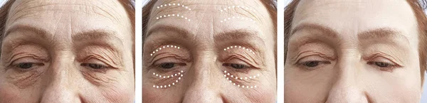 Ηλικιωμένη Γυναίκα Ρυτίδες Πριν Και Μετά Από Διαδικασίες — Φωτογραφία Αρχείου