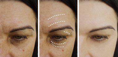 kadın kırışıklıkları öncesi ve sonrası yordamları