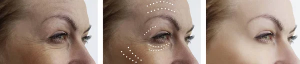 Woman Wrinkles Treatments — Stock Photo, Image