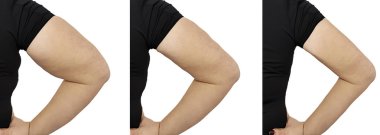 kadın şişman el öncesi ve sonrası yordamları