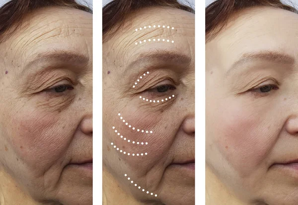 Arrugas Ancianas Antes Después Los Tratamientos — Foto de Stock