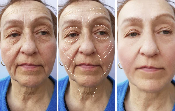 Old Woman Wrinkles Treatments — Stock Photo, Image