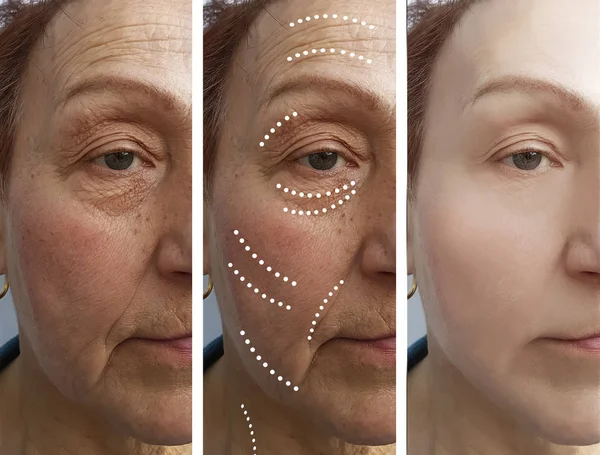 Arrugas Ancianas Antes Después Los Tratamientos — Foto de Stock