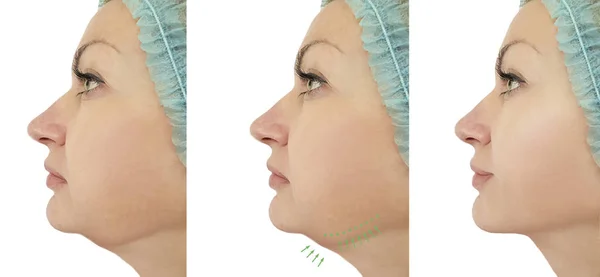 Woman Chin Lift Procedures — Stock Photo, Image