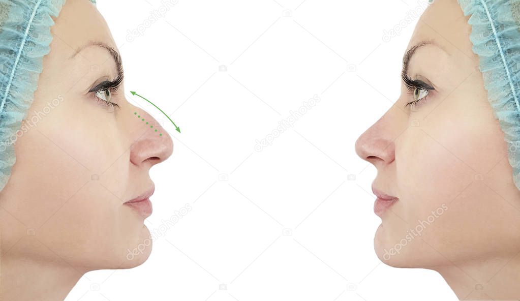 woman nose correction before and after procedures