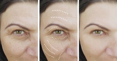 kadın yüz kırışıklıklar önce ve sonra düzeltme