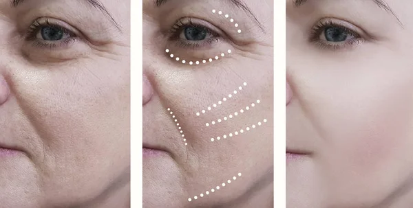Kadın Kırışıklıkları Öncesi Tedavi Sonrası — Stok fotoğraf