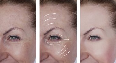 kadın kırışıklıkları yüz öncesi ve tedavi sonrası