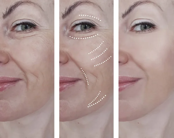Wanita Keriput Wajah Sebelum Dan Sesudah Perawatan — Stok Foto