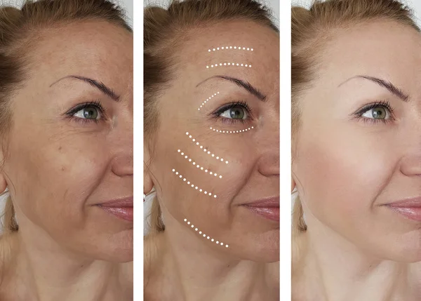 woman wrinkles face before and after treatments