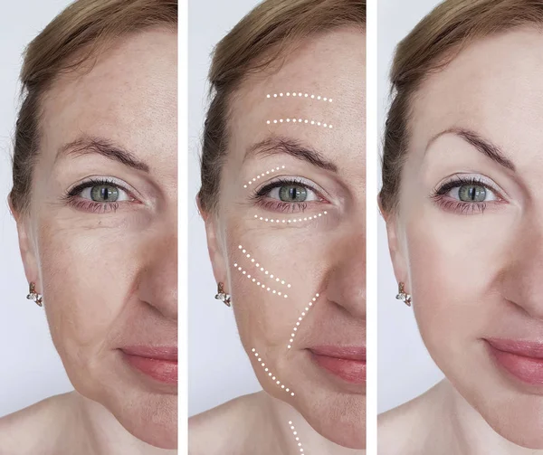 Kadın Kırışıklıkları Yüz Öncesi Tedavi Sonrası — Stok fotoğraf