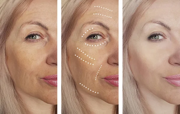 Arrugas Mujer Antes Después Los Procedimientos Corrección —  Fotos de Stock