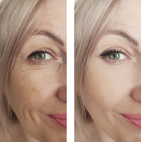 woman wrinkles before and after treatments