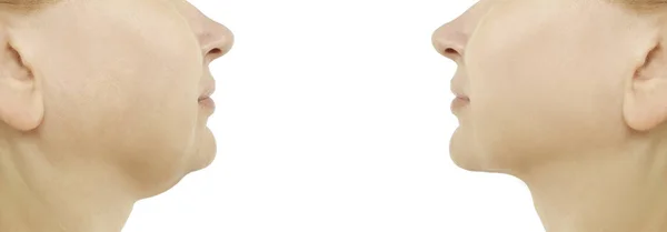 Kadın Çift Çene Öncesi Sonrası Yordamları Oval Rötuş — Stok fotoğraf