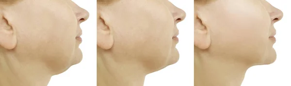 妇女双下巴前后的程序 椭圆形修饰 — 图库照片