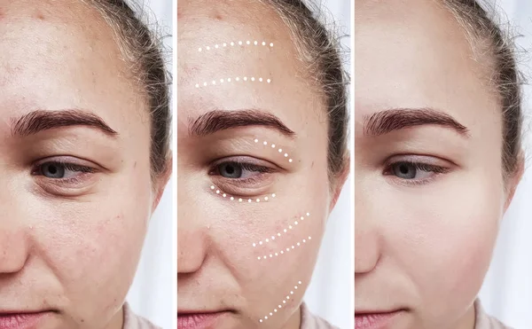 Female Eyes Wrinkles Treatments — Stock Photo, Image