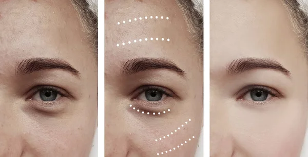 Ojos Femeninos Arrugas Antes Después Los Tratamientos — Foto de Stock