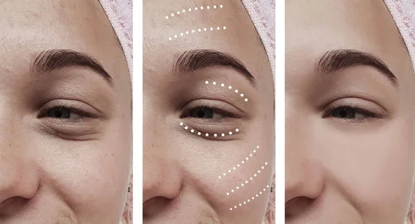 Женские Морщины Глаз После Процедур — стоковое фото