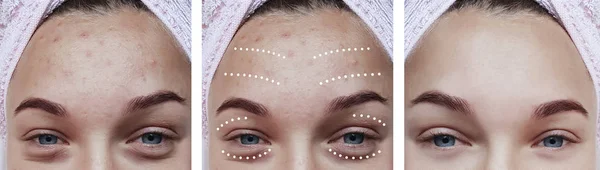 Kadın Göz Kırışıklıkları Öncesi Tedavi Sonrası — Stok fotoğraf