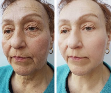 Yaşlı bir kadının yüz kırışıklıklar önce ve sonra yordamları