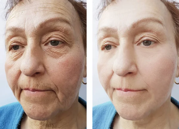 Face Old Woman Wrinkles Procedures — Stock Photo, Image