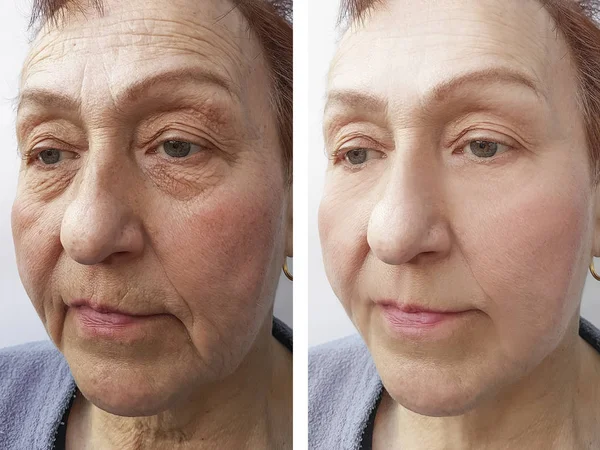 Face Old Woman Wrinkles Procedures — Stock Photo, Image