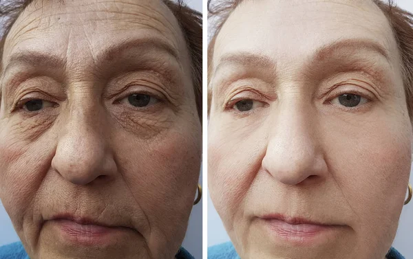 Face Old Woman Wrinkles Procedures — Stock Photo, Image