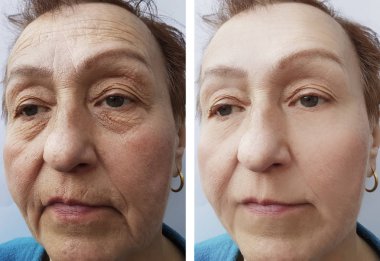 Yaşlı bir kadının yüz kırışıklıklar önce ve sonra yordamları